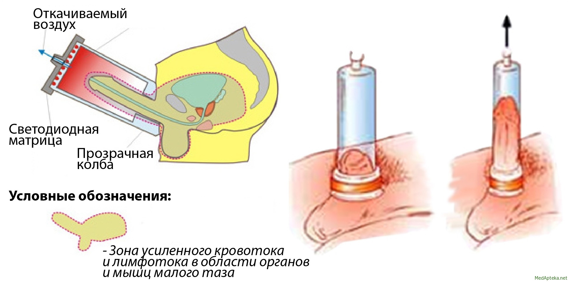 Помпа для увеличения члена: механизм действия