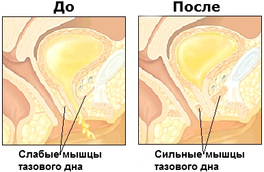 использование вагинальных шариков